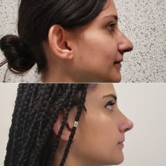 Rinoplastia Mujer -Dr. Edgar Ramírez López