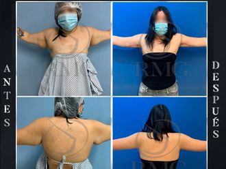 Braquioplastia - 789003