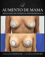 Aumento mamario