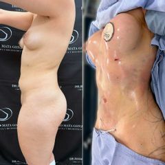 Liposucción - Dr. Rodrigo Mata González