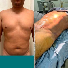 Marcaje Abdominal - Dr. Rodrigo Mata González