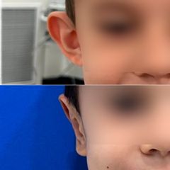 Otoplastia - Dr. Rodrigo Mata González