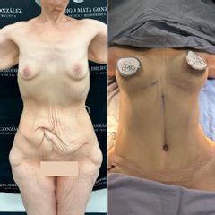 Cirugía Postbariatrica - Dr. Rodrigo Mata González