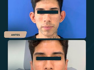 Otoplastia antes y después - 873140