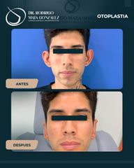 Otoplastia - Dr. Rodrigo Mata González