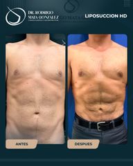 Liposucción HD - Dr. Rodrigo Mata González