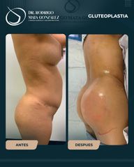 Gluteoplastia - Dr. Rodrigo Mata González