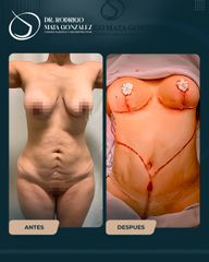 Mommy Makeover - Dr. Rodrigo Mata González