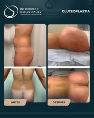 Gluteoplastia - Dr. Rodrigo Mata González