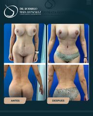 Mommy Makeover - Dr. Rodrigo Mata González
