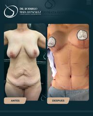 Mommy Makeover - Dr. Rodrigo Mata González