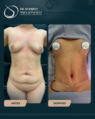 Mommy Makeover - Dr. Rodrigo Mata González
