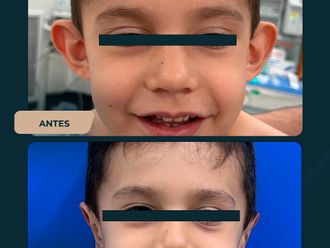 Otoplastia antes y después - 873776