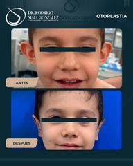 Otoplastia - Dr. Rodrigo Mata González