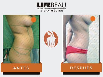 Lipoescultura - 632727