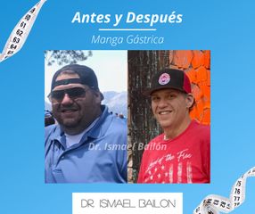 Manga gástrica - Dr. Ismael Bailon