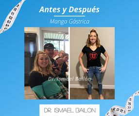 Manga gástrica - Dr. Ismael Bailon