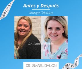 Manga gástrica - Dr. Ismael Bailon