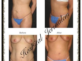 Antes y después de Lipoescultura