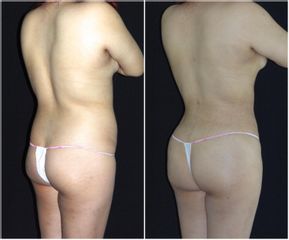 Liposucción - Dr. José Luis Valero Salas