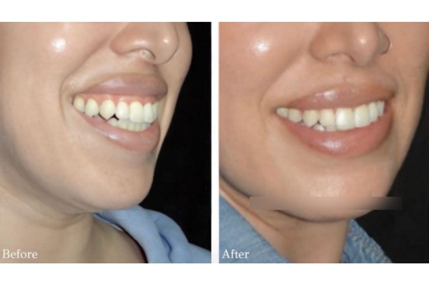 Aumento de labios antes y después - 839346