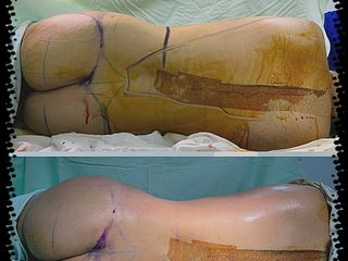 Antes y después de LIPO CON J PLASMA RENUVION.