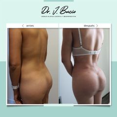 Antes y después de Gluteoplastia 