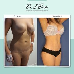 Antes y después de Liposucción 