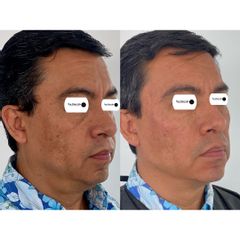 Rejuvenecimiento facial - Dr. Irvin J Cervantes