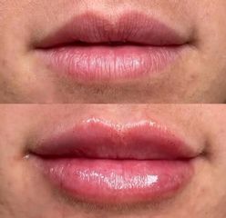 Aumento labios - Dr. Irvin J Cervantes