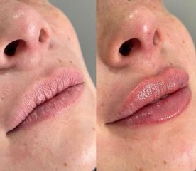 Aumento de labios - Dr. Irvin J Cervantes