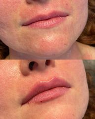 Aumento de labios - Dr. Irvin J Cervantes