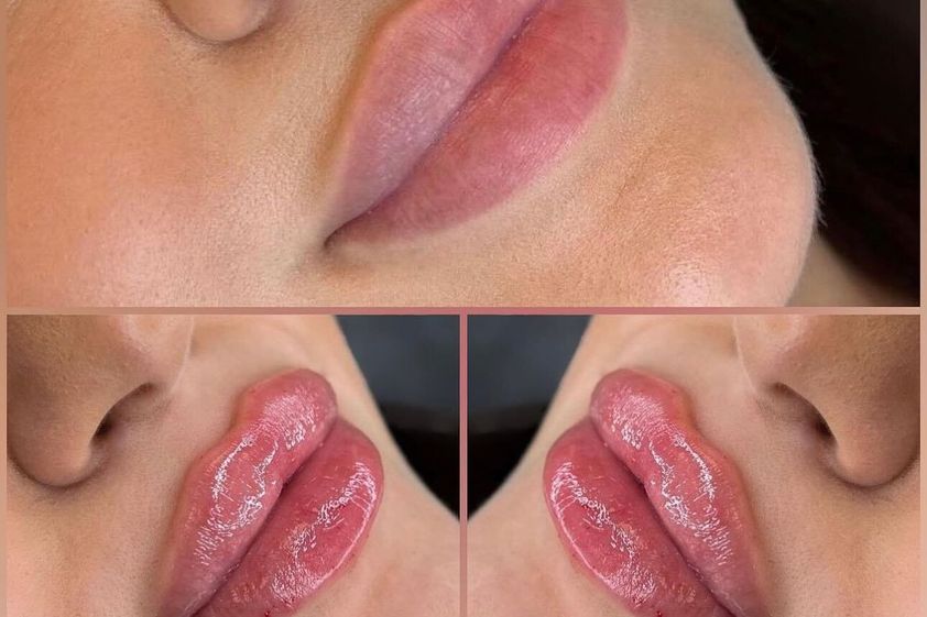 Aumento de labios antes y después - 864772