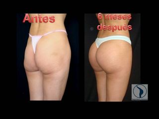Antes y después de Aumento de Glúteos