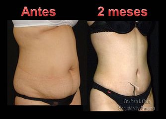 Lipo-abdominoplastía 