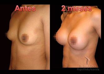 Antes y después de Aumento de busto