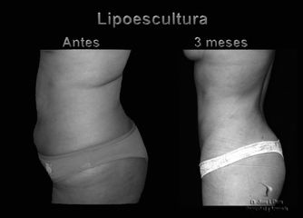 Antes y después de Lipoescultura