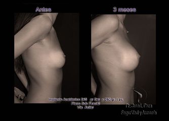 Antes y después de Mamoplastia