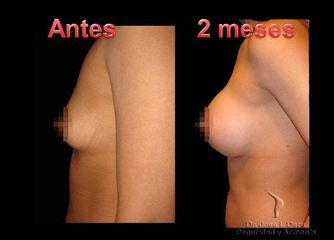 Antes y después de Mamoplastia