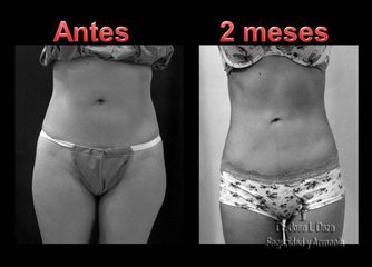 Antes y después de Lipoescultura