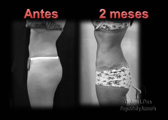 Antes y después de Lipoescultura