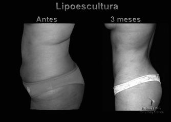 Antes y después de Lipoescultura