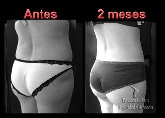 Antes y después de Lipoescultura