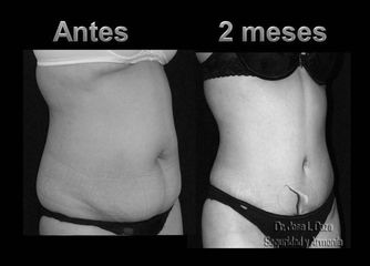 Antes y después de Lipo-abdominoplastia