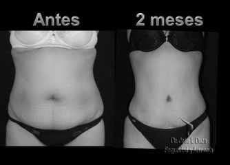 Antes y después de Lipo-abdominoplastia