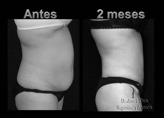 Antes y después de Lipo-abdominoplastia