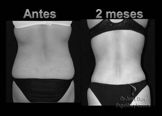 Antes y después de Lipo-abdominoplastia