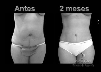 Antes y después de Lipo-abdominoplastia