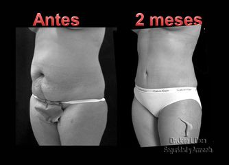 Antes y después de Lipo-abdominoplastia