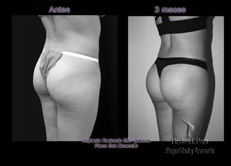 Antes y después de Implantes glúteos